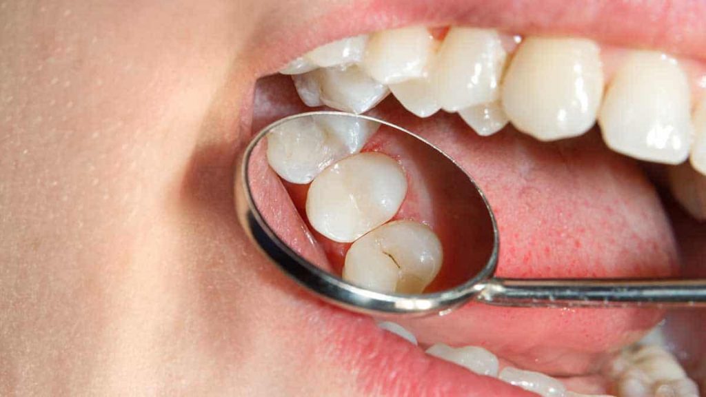 problemas con las caries dental