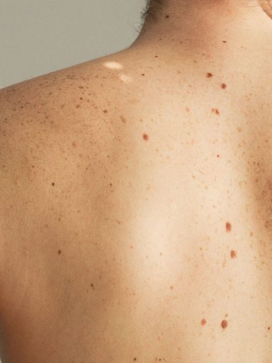 fuerte cáncer en la piel